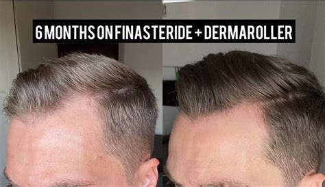 propecia results after 6 months.